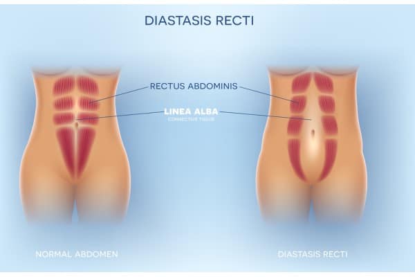 What Non-Surgical Options Are Available for Diastasis Recti Wellingborough?