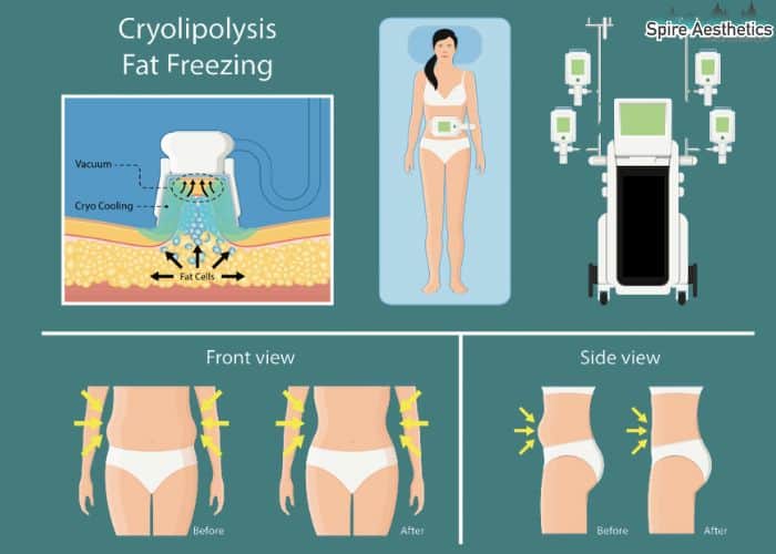Image of diet and fat freezing combined for best results for Spire Aesthetics Wellingborough