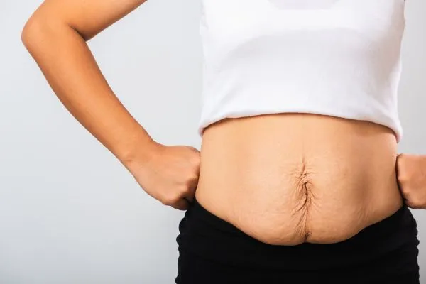 Image of a woman's stomach after weight loss with sagging skin following a gastric band Wellingborough