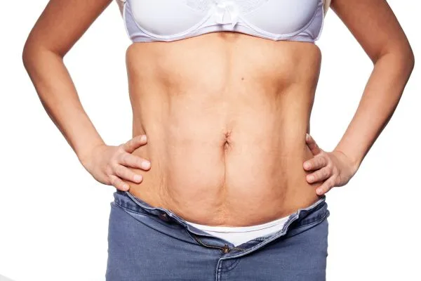 sagging skin on woman's stomach after weight loss injections Wellingborough