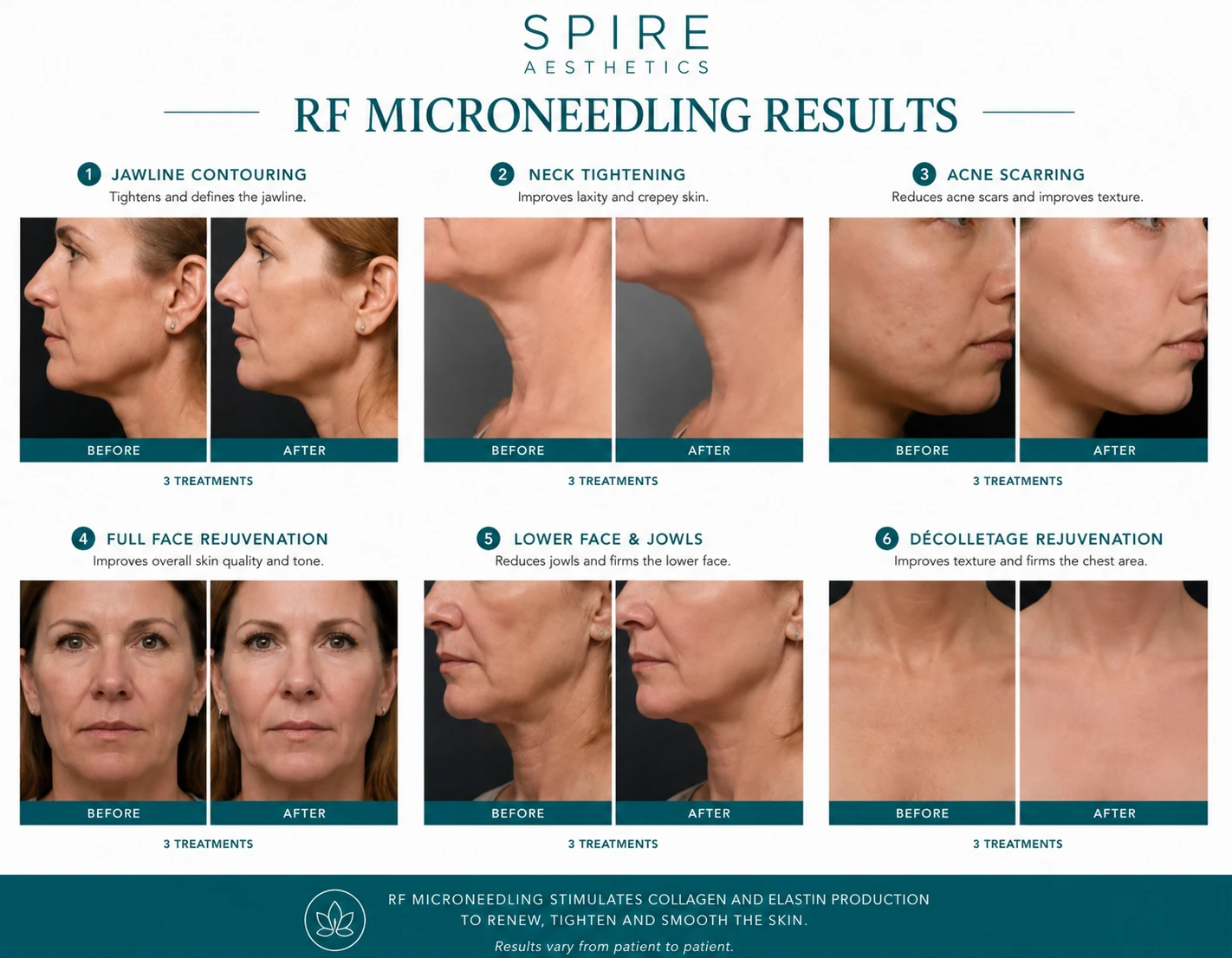 RF Microneedling Skin tightening Wellingborough results