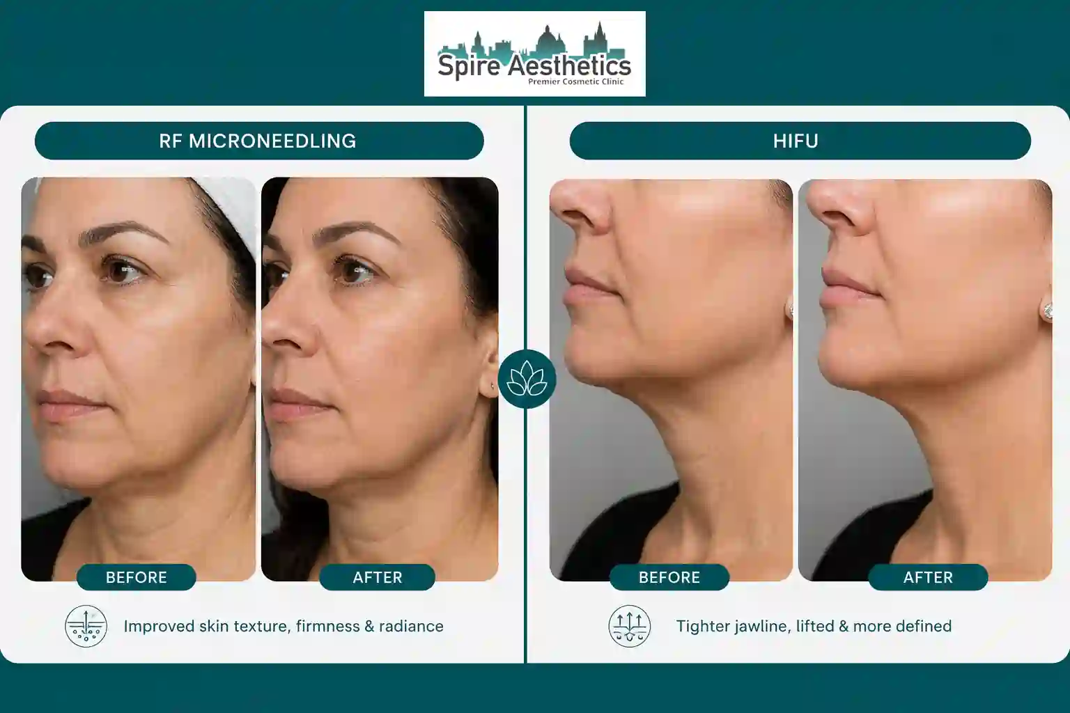 Can RF Microneedling and HIFU Be Combined Wellingborough?