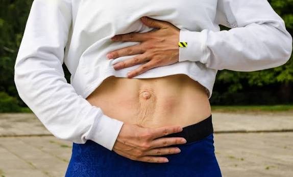 When Could Diastasis Recti Be the Missing Piece of the Puzzle Wellingborough?