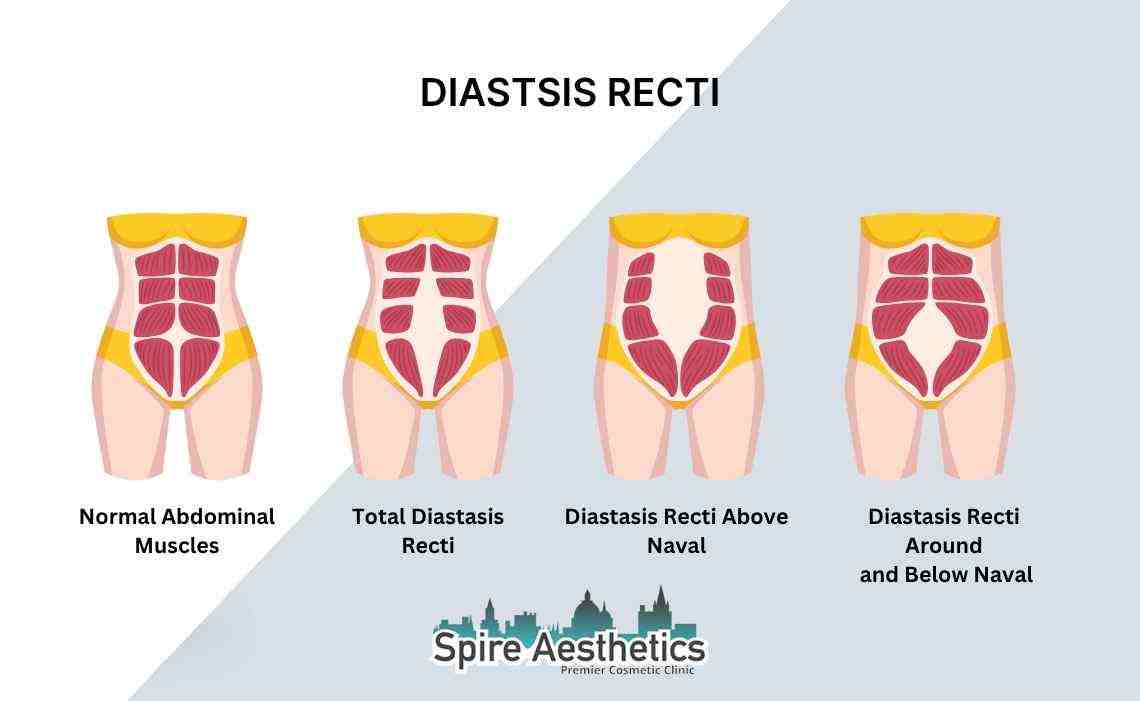 Is Non-Surgical Diastasis Recti Treatment Right for You? Common Concerns Answered Wellingborough